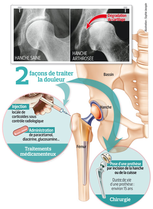 Arthrose de la hanche la recherche avance